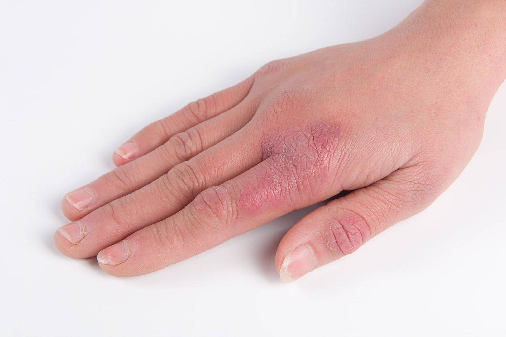 得了湿疹,忌口是铁律!医生:这5类食物要忌口,避免病情反复