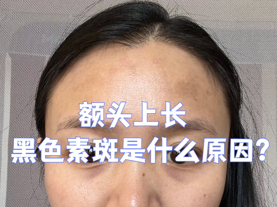 额头上长黑色素斑是什么原因?