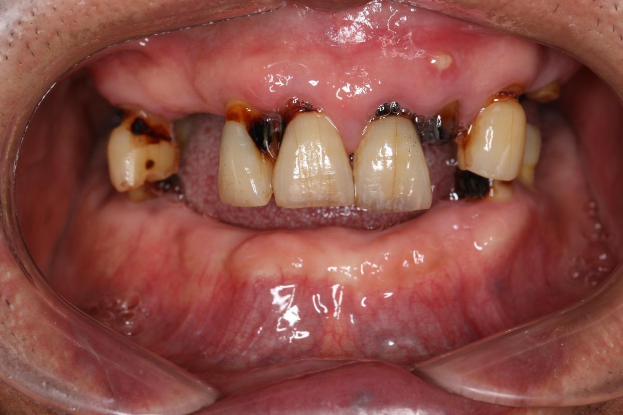 齿间早讯|根面龋:隐形的老龄牙齿杀手,如何早预防?