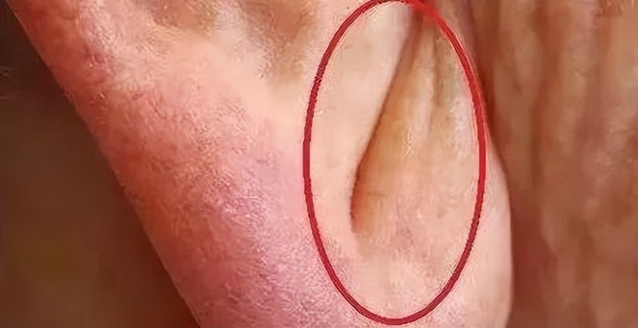 耳朵是"心梗"的放大镜?医生提醒:耳朵出现4个异常,及时就医