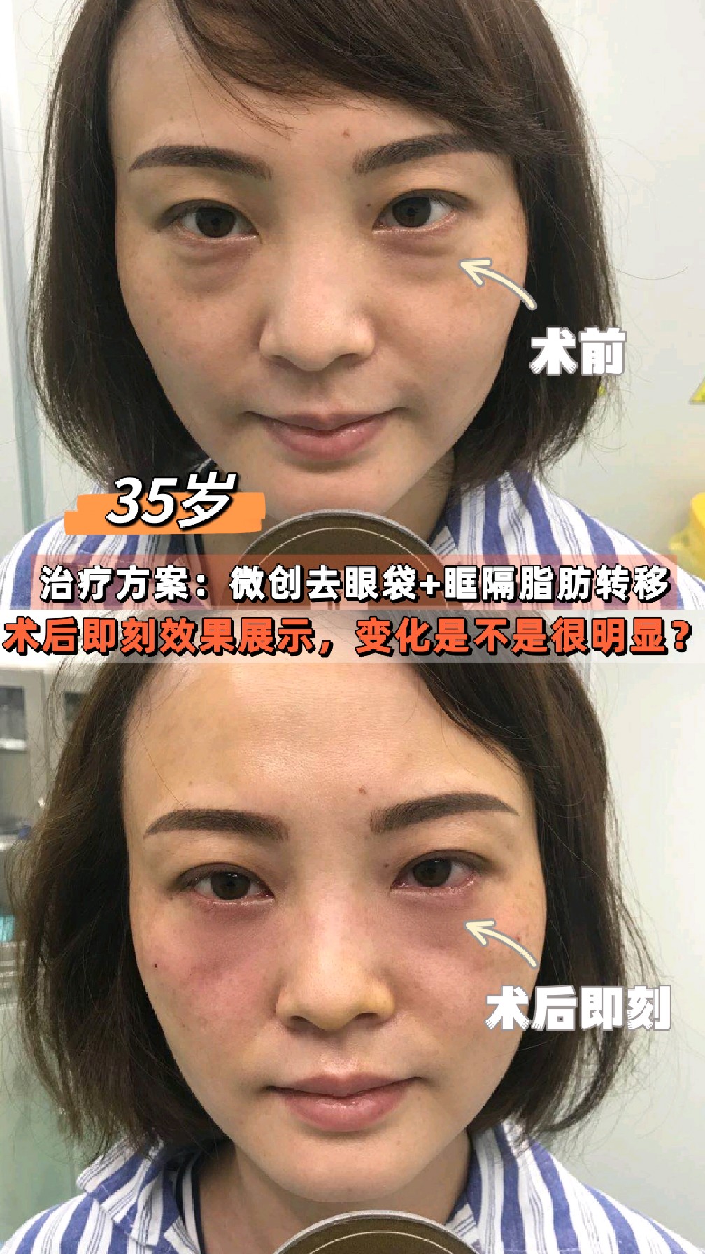 35岁女士眼袋泪沟合并,通过微创去眼袋 泪沟填充,术后即刻效果展示