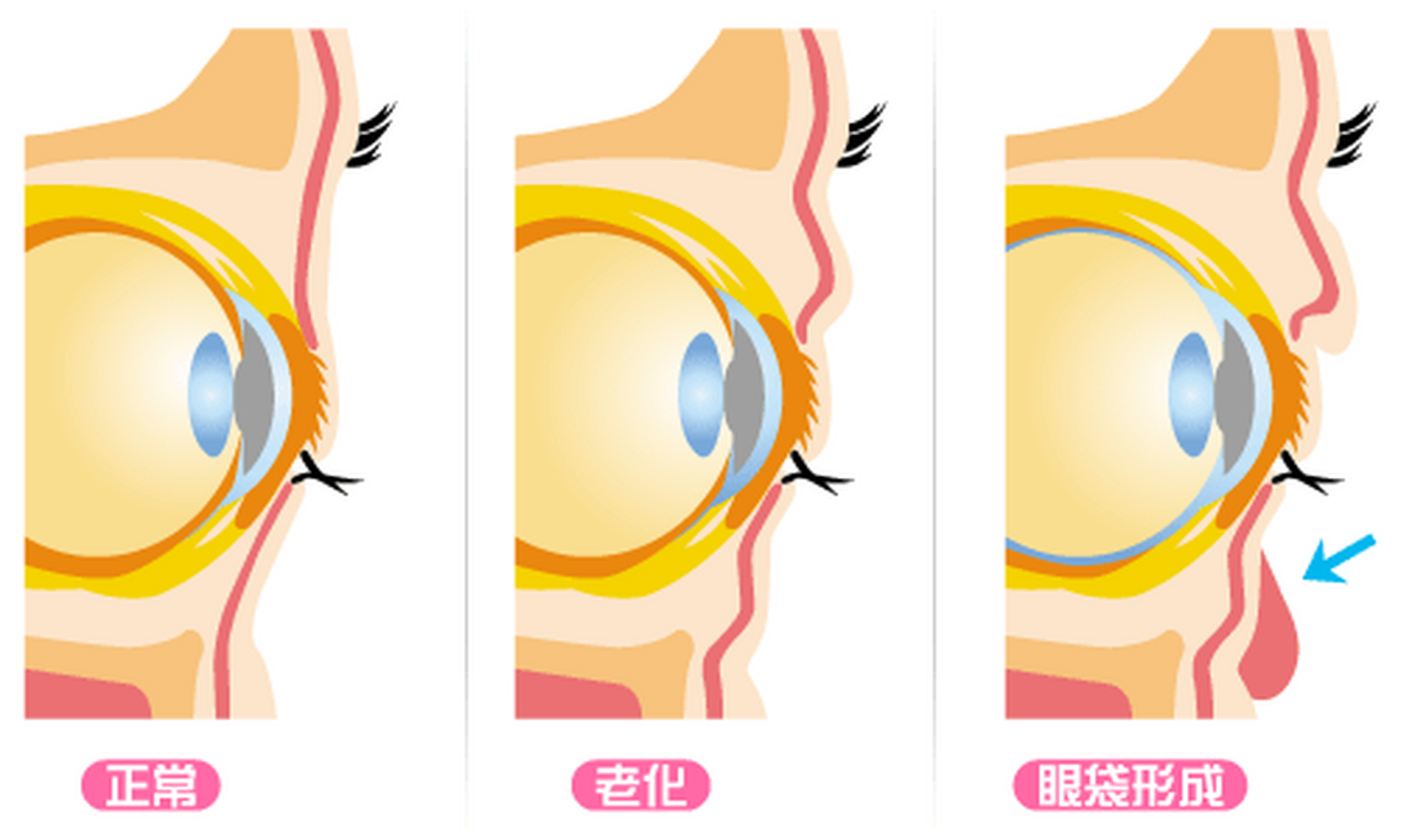 眶隔脂肪在哪里图片