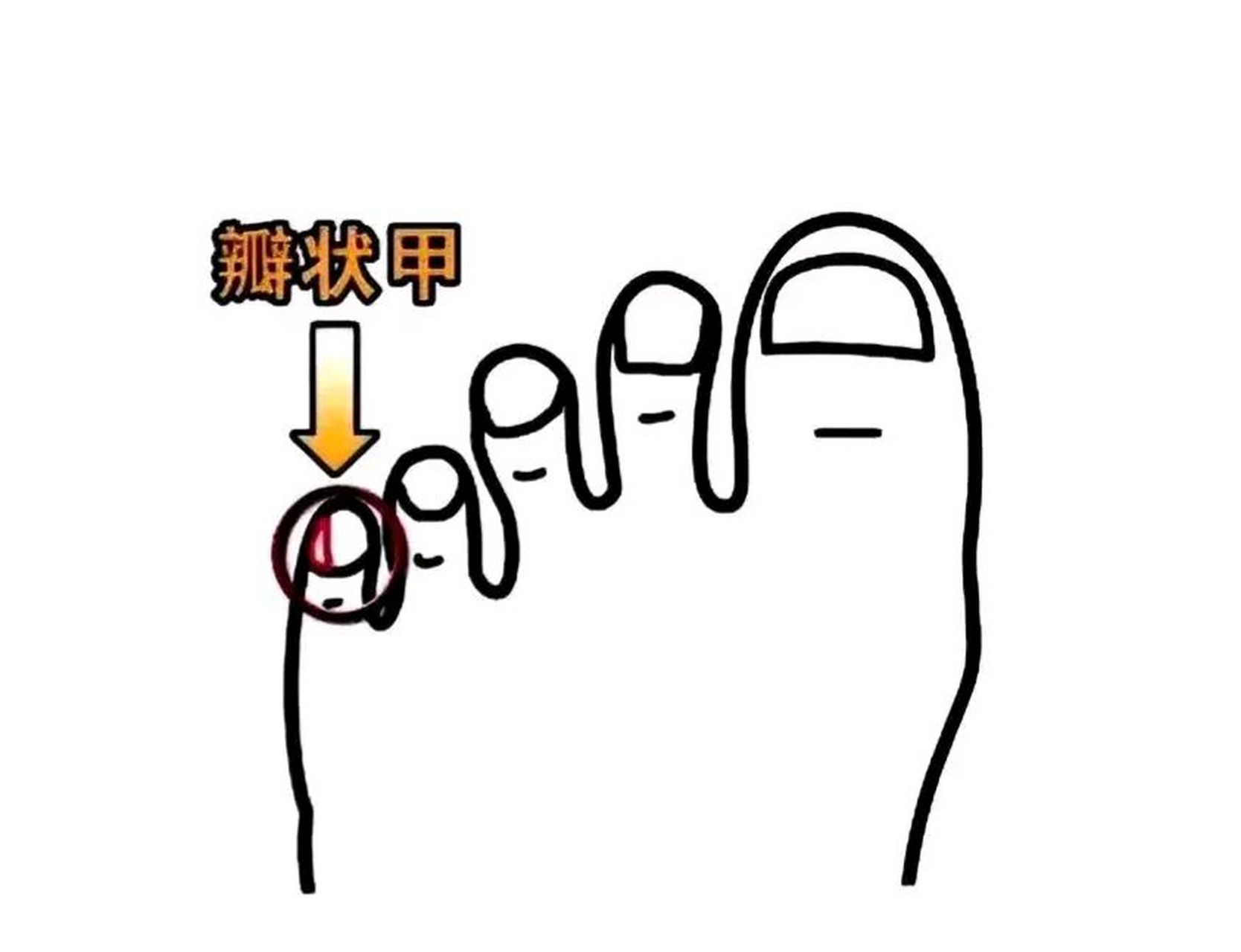 这种叫跰趾,医学上称为瓣状甲.