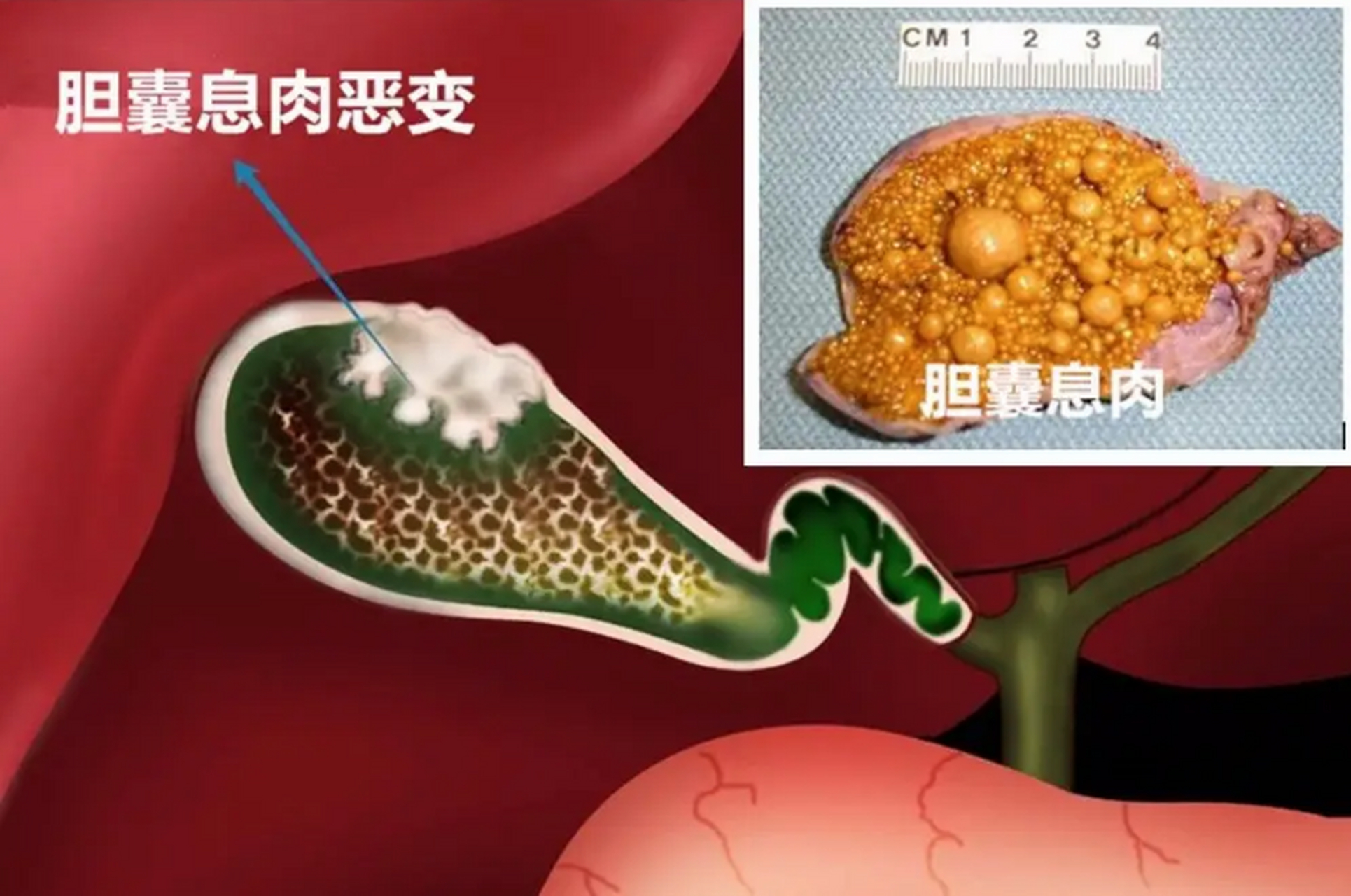 胆囊息肉是怎么引起的图片