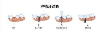 种牙一般费用多少