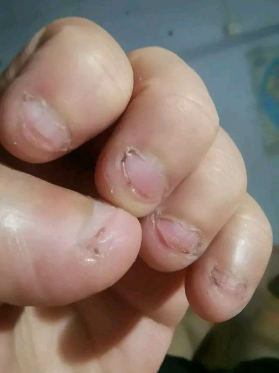 总是忍不住咬指甲怎么办?