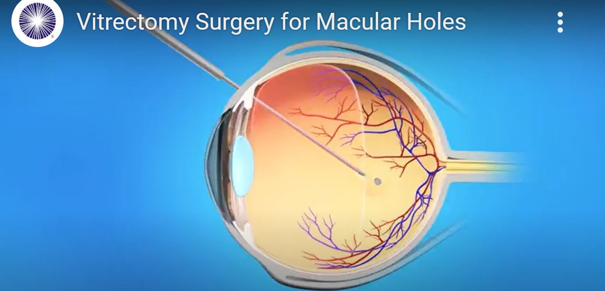 一文读懂黄斑裂孔的手术治疗