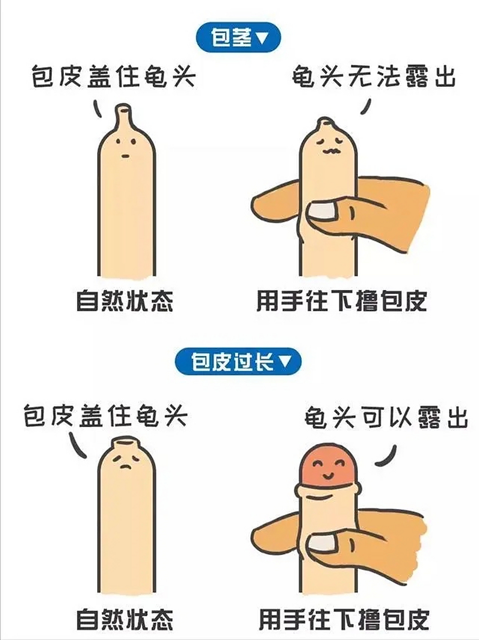 给大家分享一篇知识: 如何区分包皮过长和包茎?