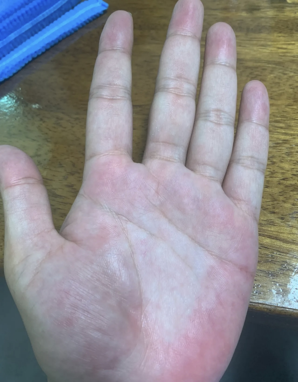 结合化验单来看,妥妥的"肝掌".