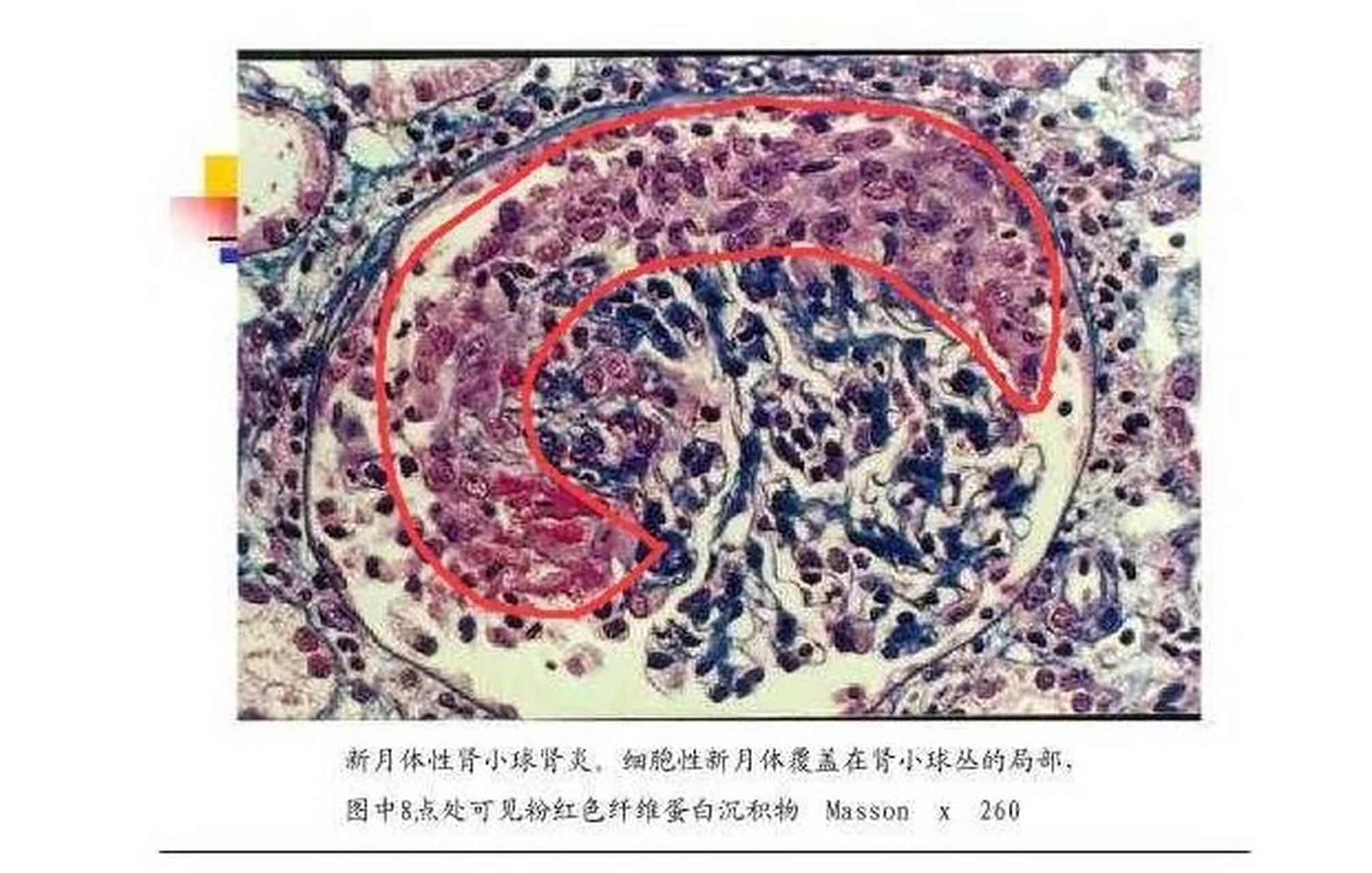 新月体肾炎:进展凶猛的标志 做肾活检时,用穿刺针取出肾脏的一小块"肉