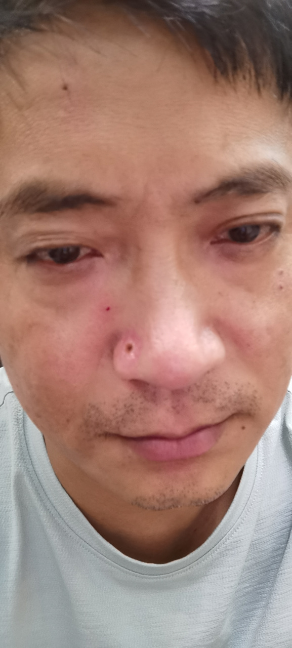 澳洲朋友,飞6000多公里聚会,直言我鼻子91上的痣不好,于是我连夜找