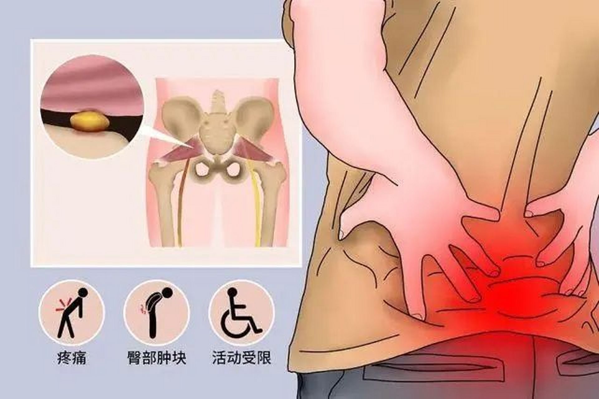 腰疼先判断是骨头疼还是肌肉疼?