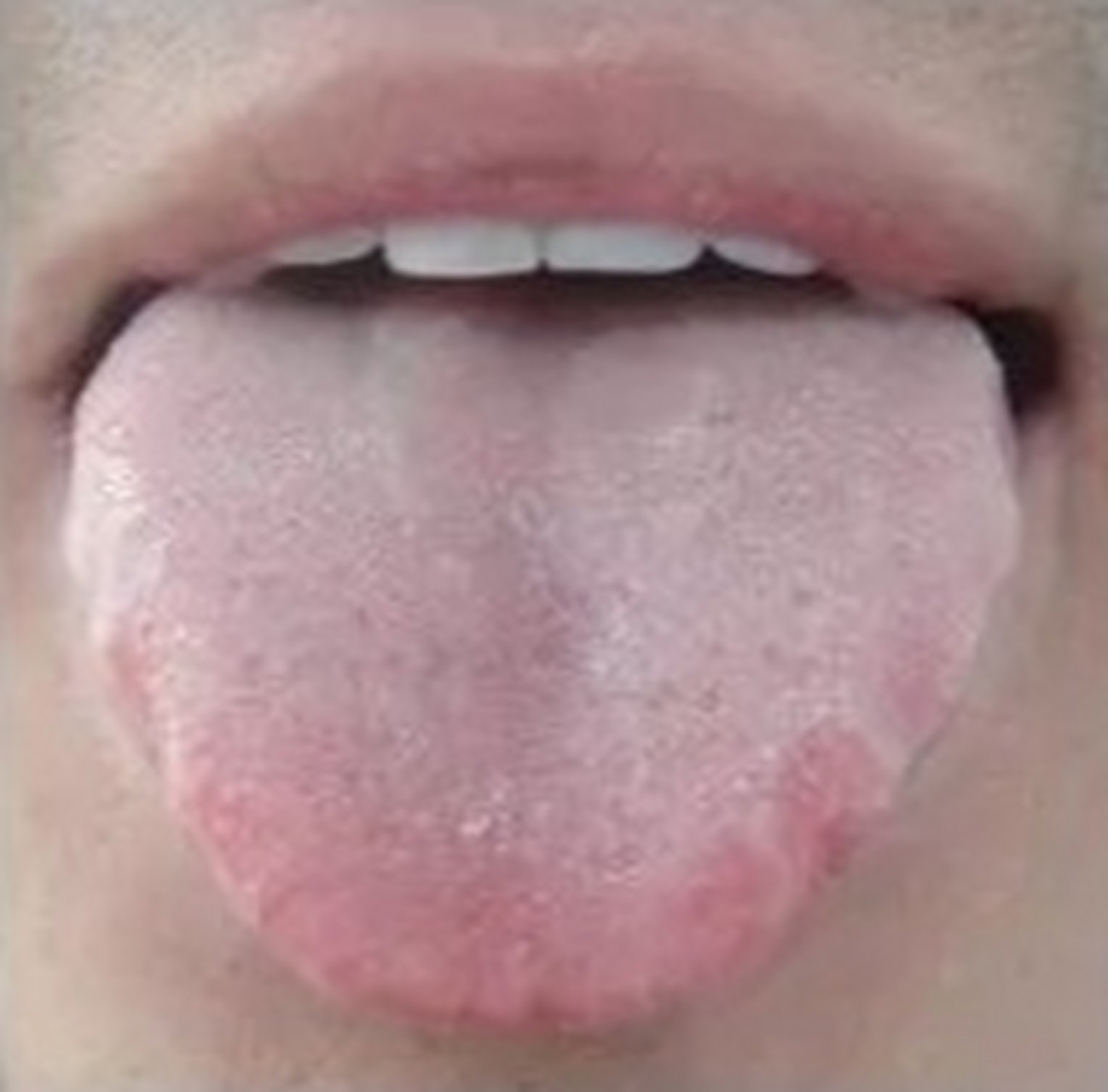 【舌诊】肥胖证型:血淤气滞型  【肝淤气滞舌象特点】 舌暗有瘀斑