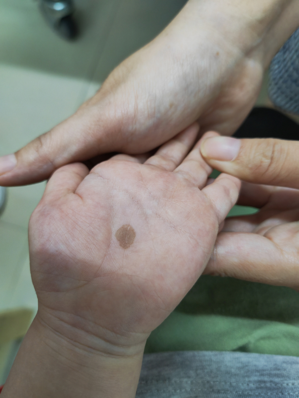 有亲戚说是胎记,但这斑块以前是没有的.