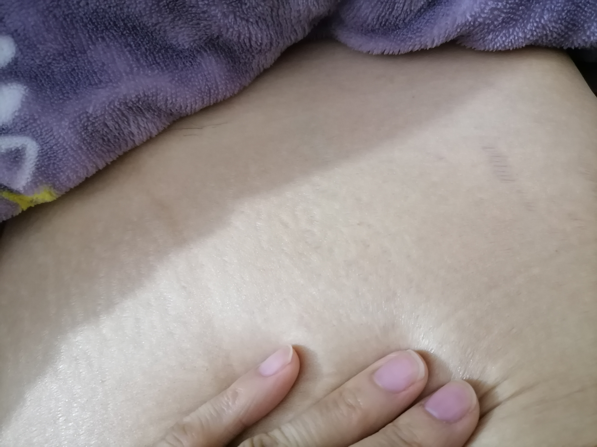 女人的"噩梦"妊娠纹