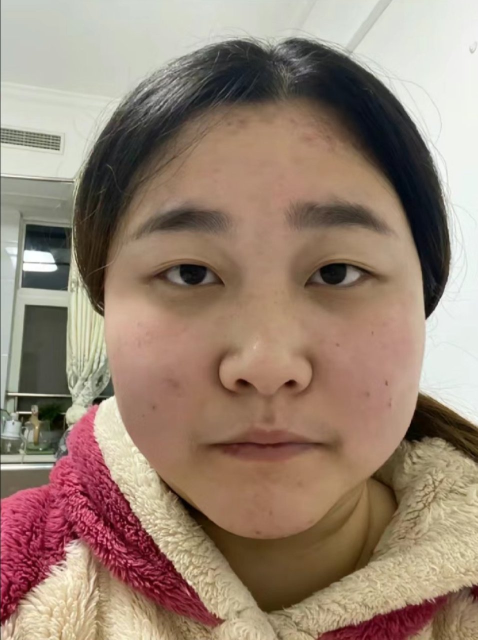 新生儿甲减面容图片