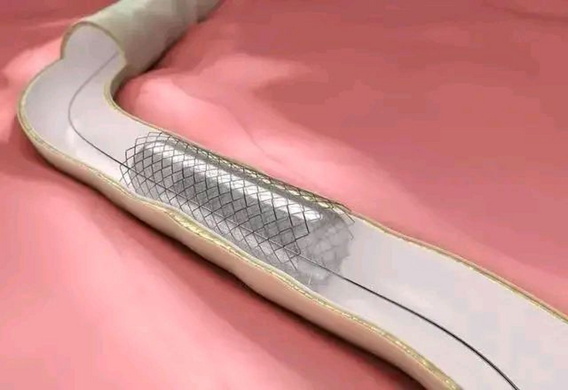 美国的进口心脏支架,又号称"有情金属",可以随人体体温热胀冷缩,2005