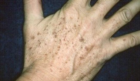 为什么老年人身上会长老年斑?建议做好这几件事,可以有效改善