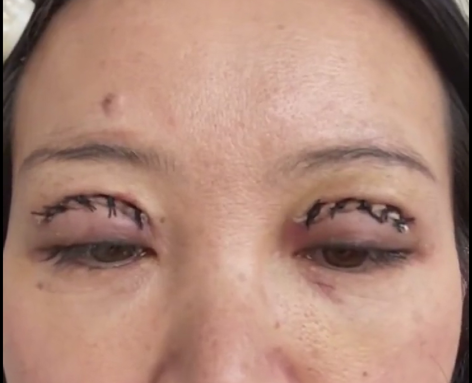 这是屠龙刀割的双眼皮吧