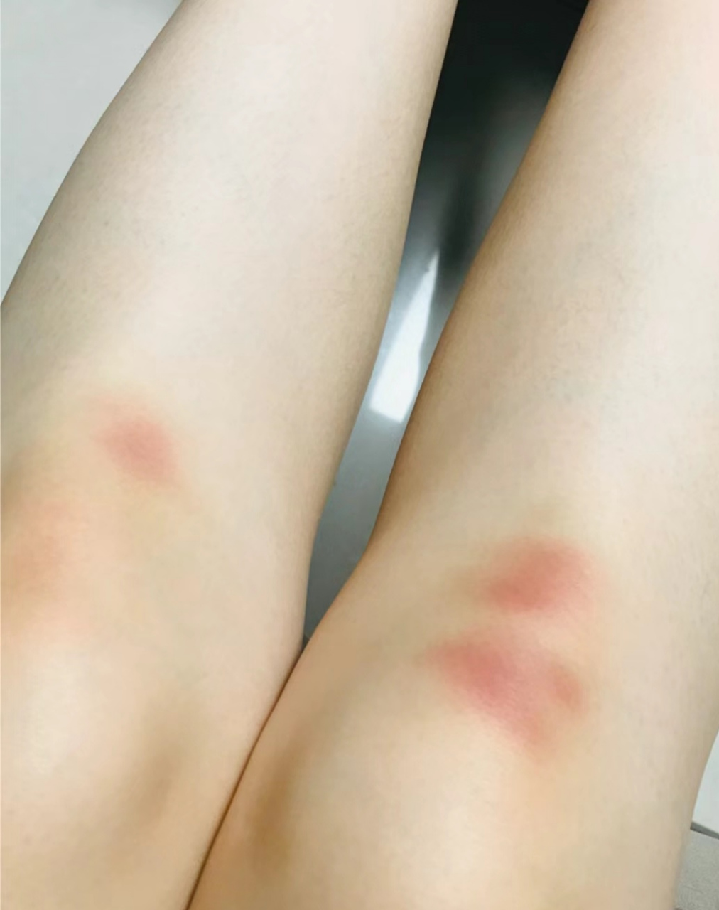 老婆每次出差回来膝盖经常有淤青,红肿.