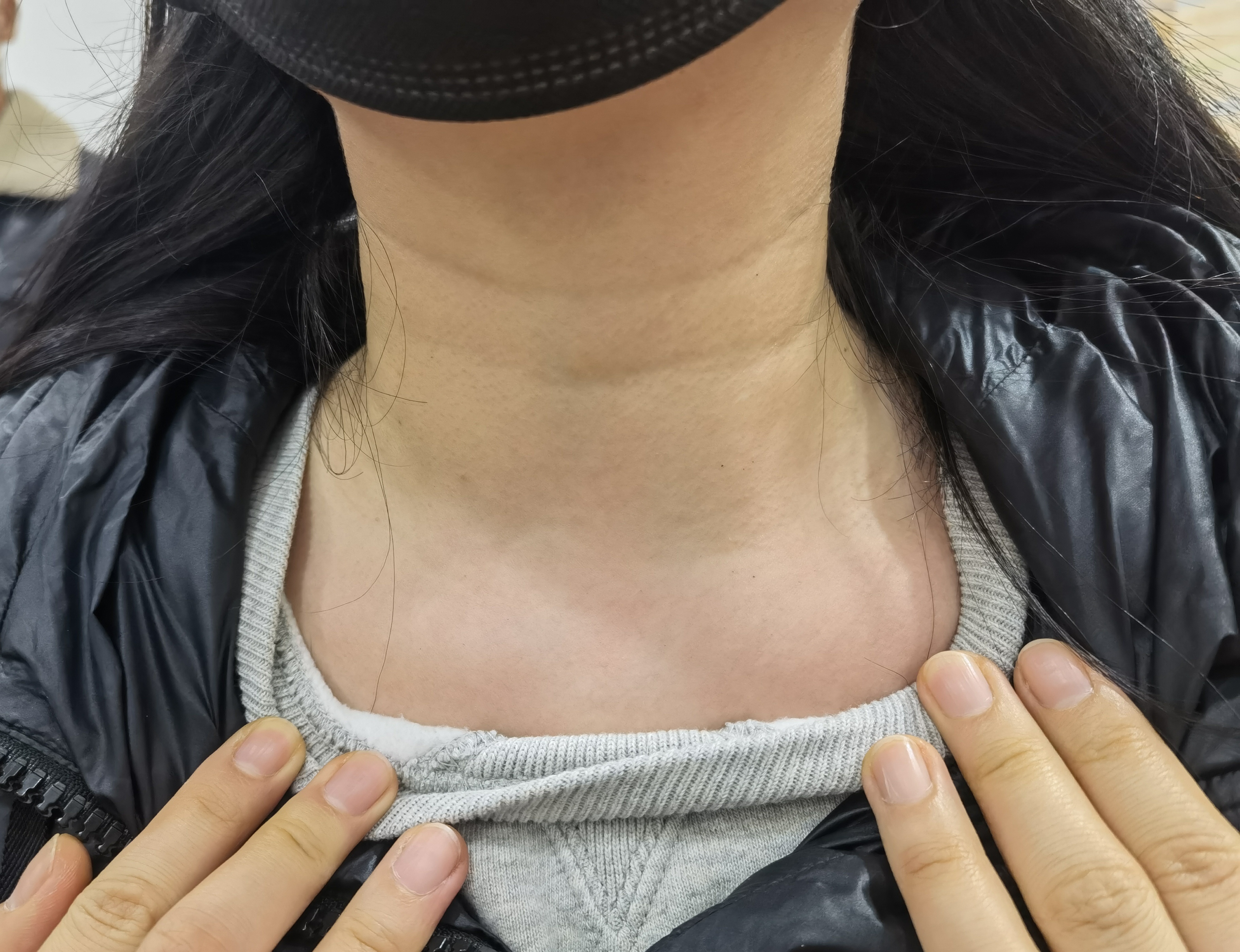 甲状腺癌术后管理