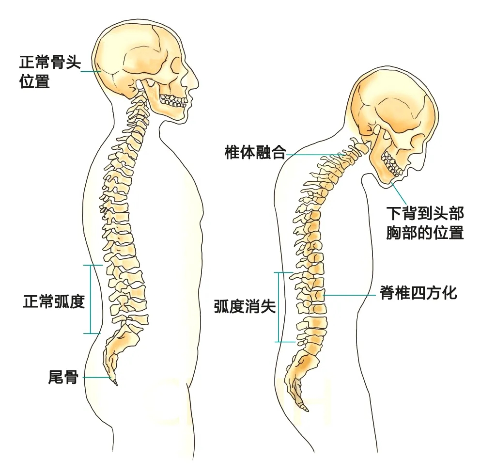 强直性脊柱炎位置图片