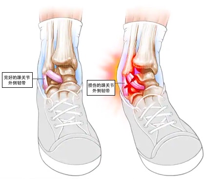 崴脚怎么判断骨头没事图片