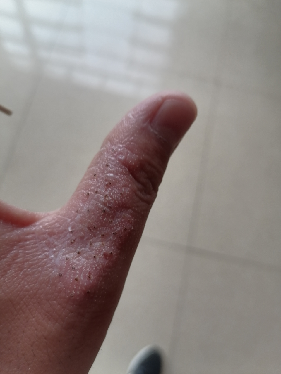 左大拇指头上长了这点癣,真的好烦人.