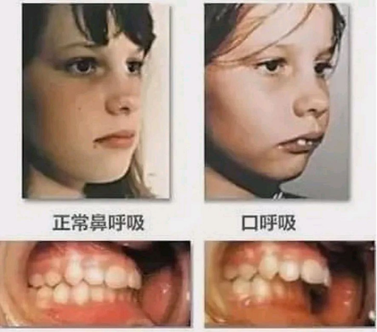 嗯哼近照疑腺样体面容引网友担心# 孩子睡觉的一个小毛病不仅影响