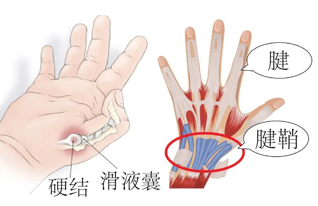 手腕痛是怎么回事图片