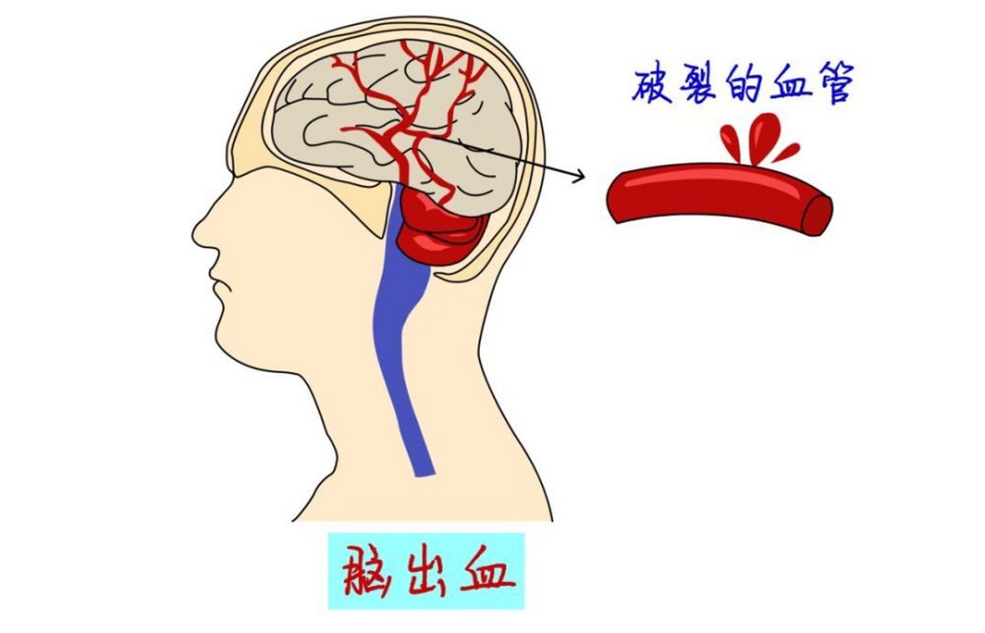 脑出血图片卡通图片