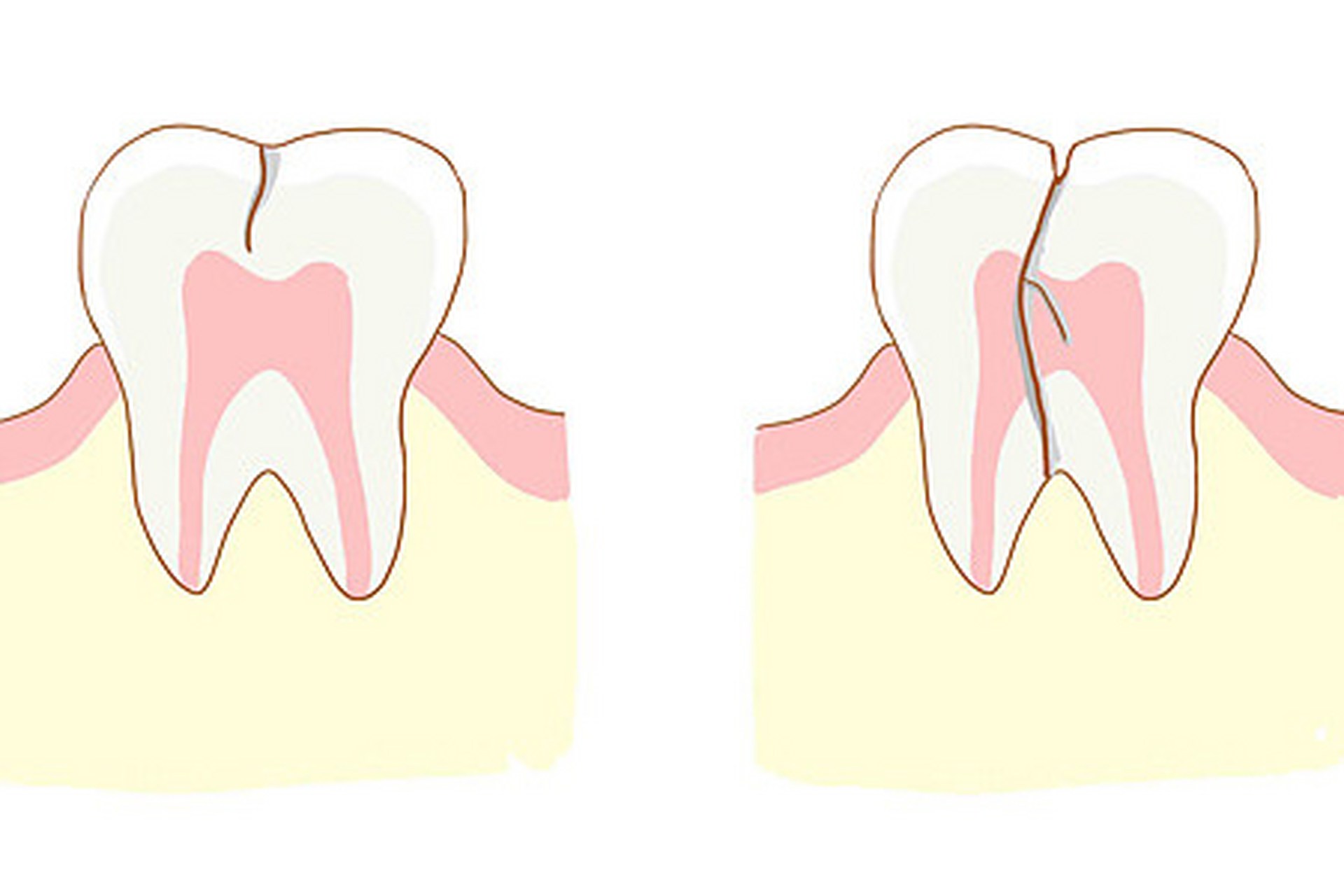 所谓牙隐裂是指牙齿表面上有细微的,人的肉眼难以发现的裂缝.