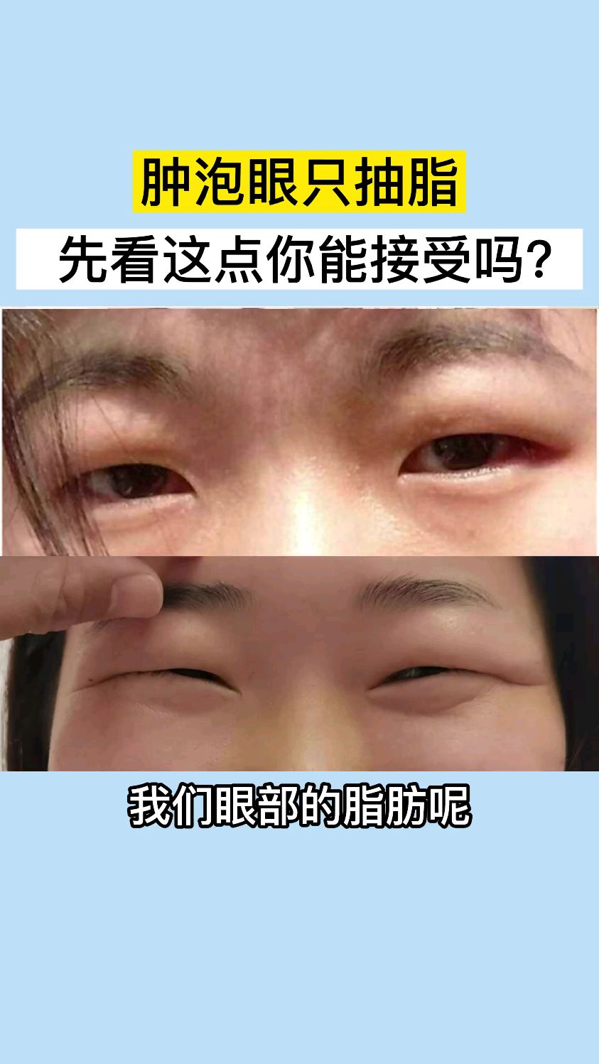 肿眼泡只抽脂先看这点你能接受吗