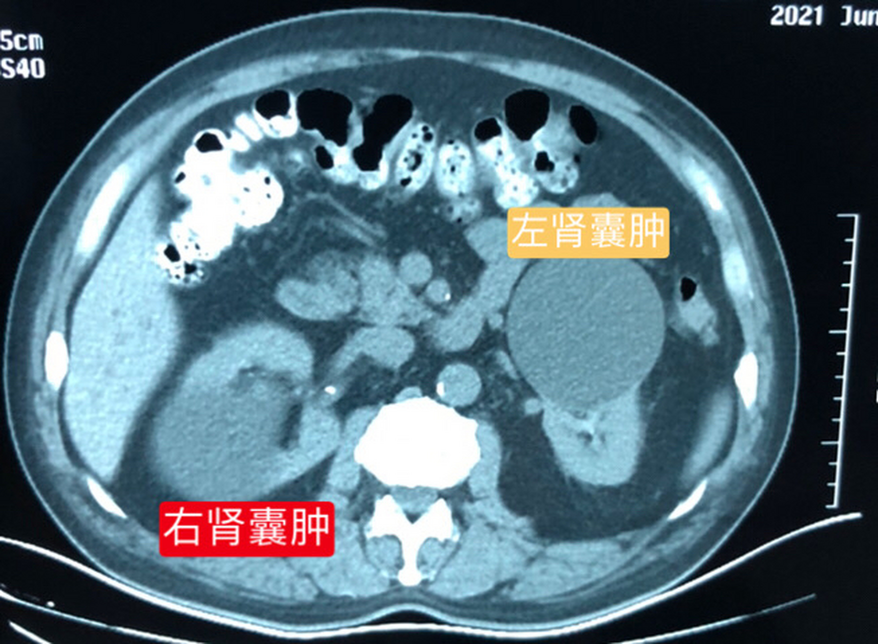 肾囊肿如何处理【患者直肠癌就诊,发现双肾囊肿 提醒患者后续定期