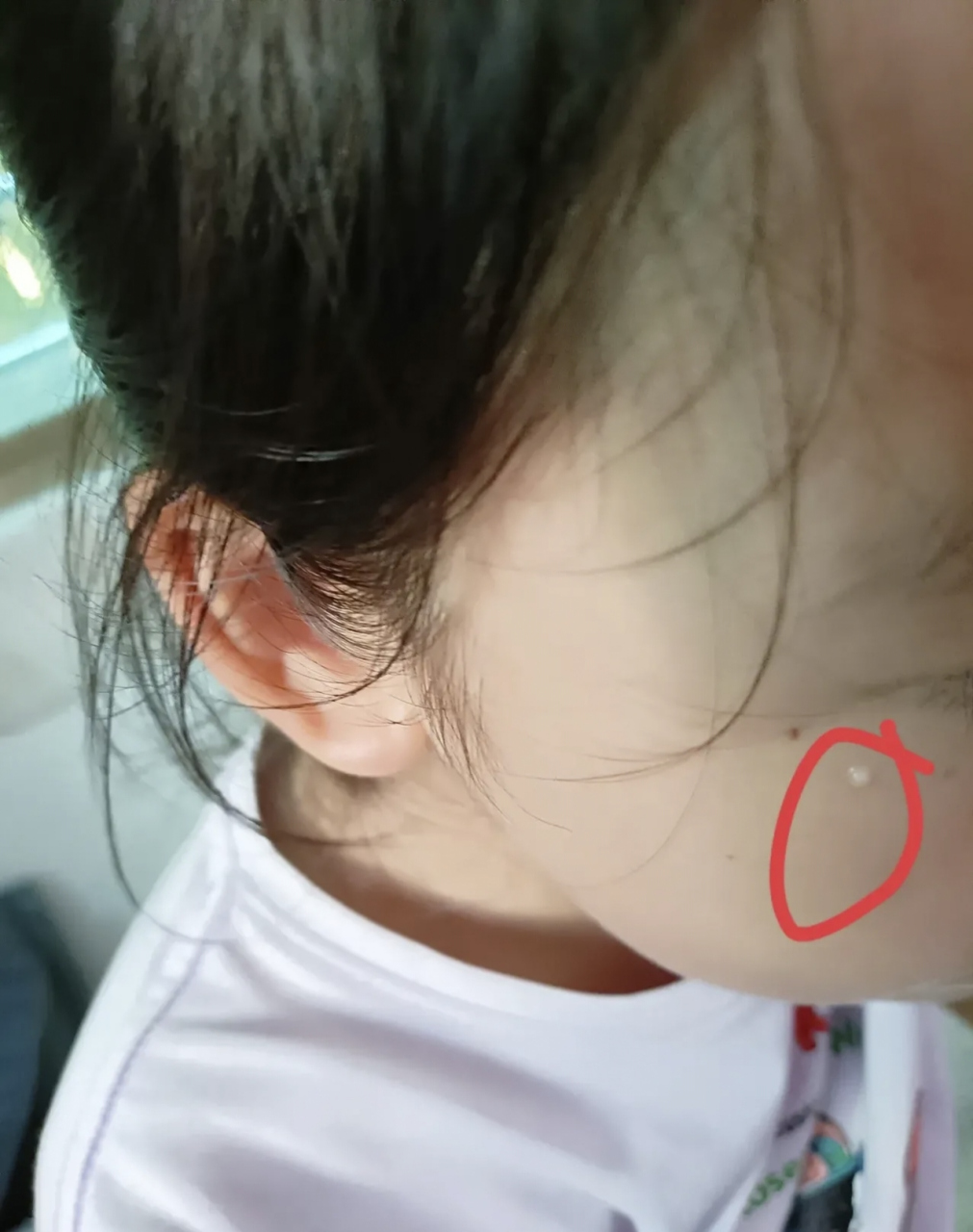 女儿脸上长了一个这样圆圆白白的东西,不知道是什么东西,被老公给发现