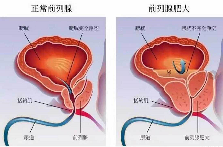 前列腺增生手术能解决什么问题