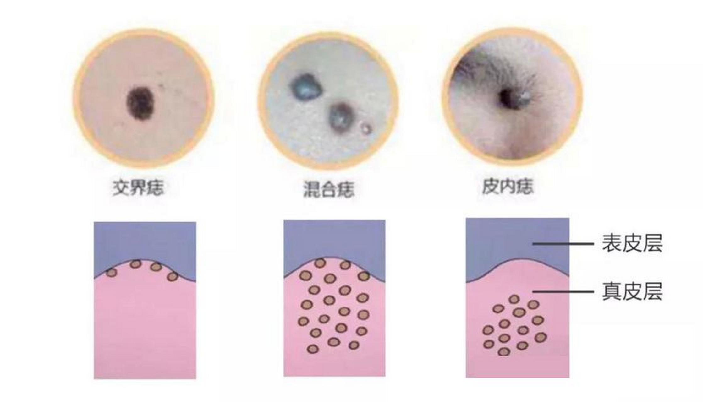 痦子和痣的区别 痦子与痣的区别就是小名和大名的区别,是一种东西.