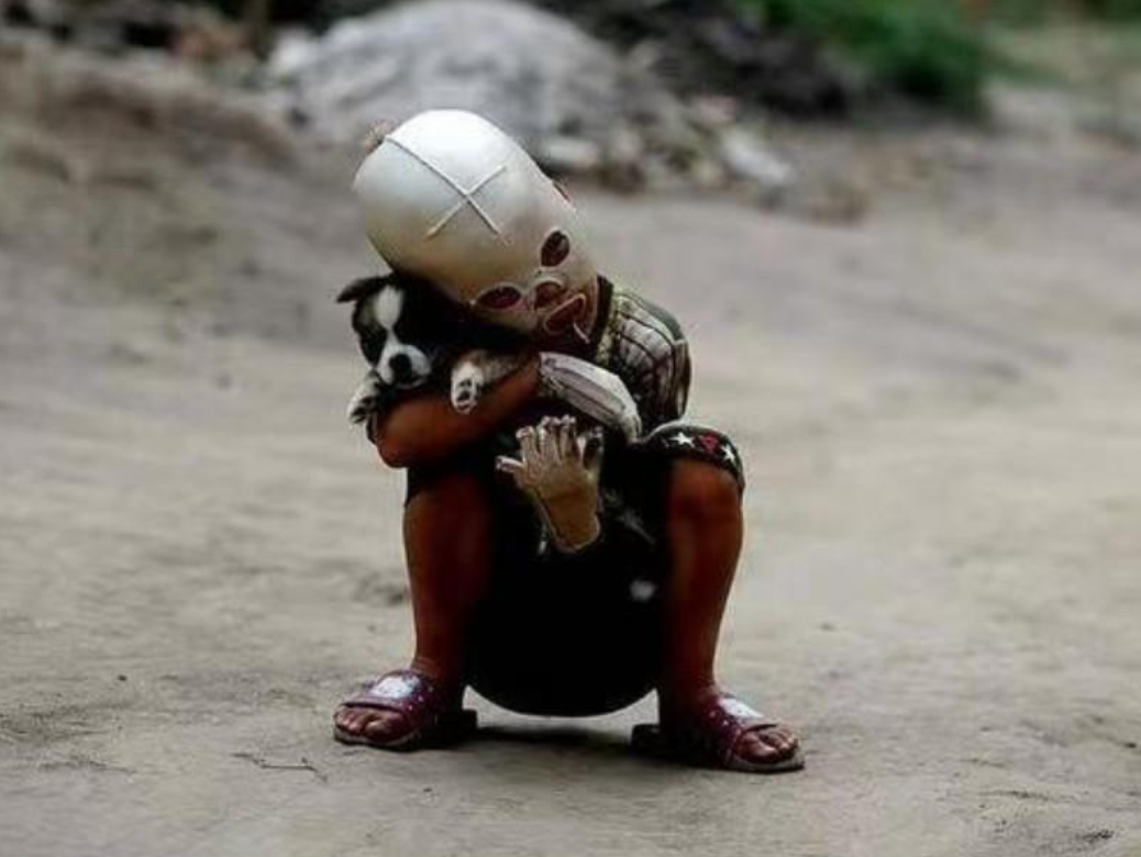 回顾山西"面具娃娃":遭大火烧伤心理扭曲,被小朋友排挤,后怎样