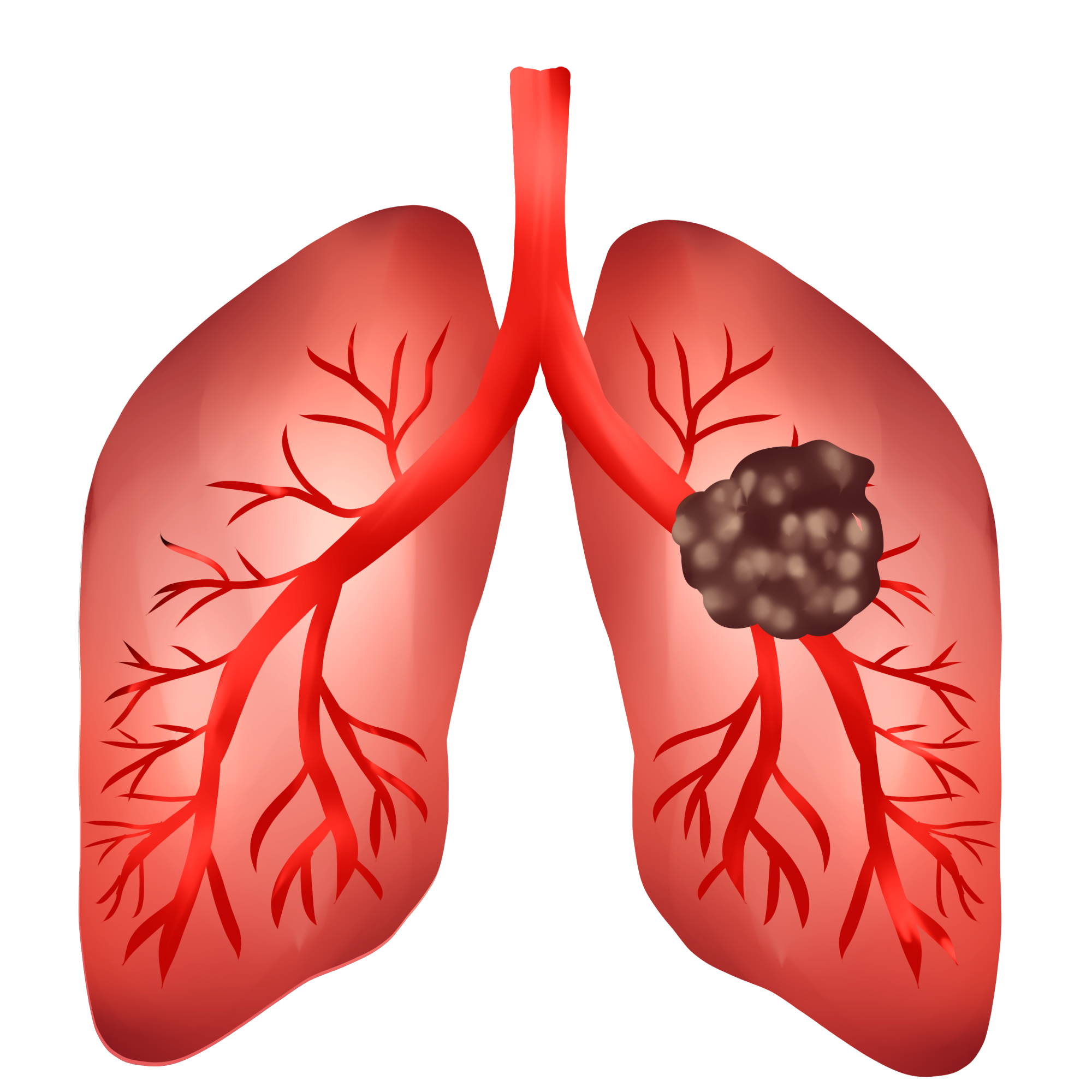 遇上肺部肿块这么办