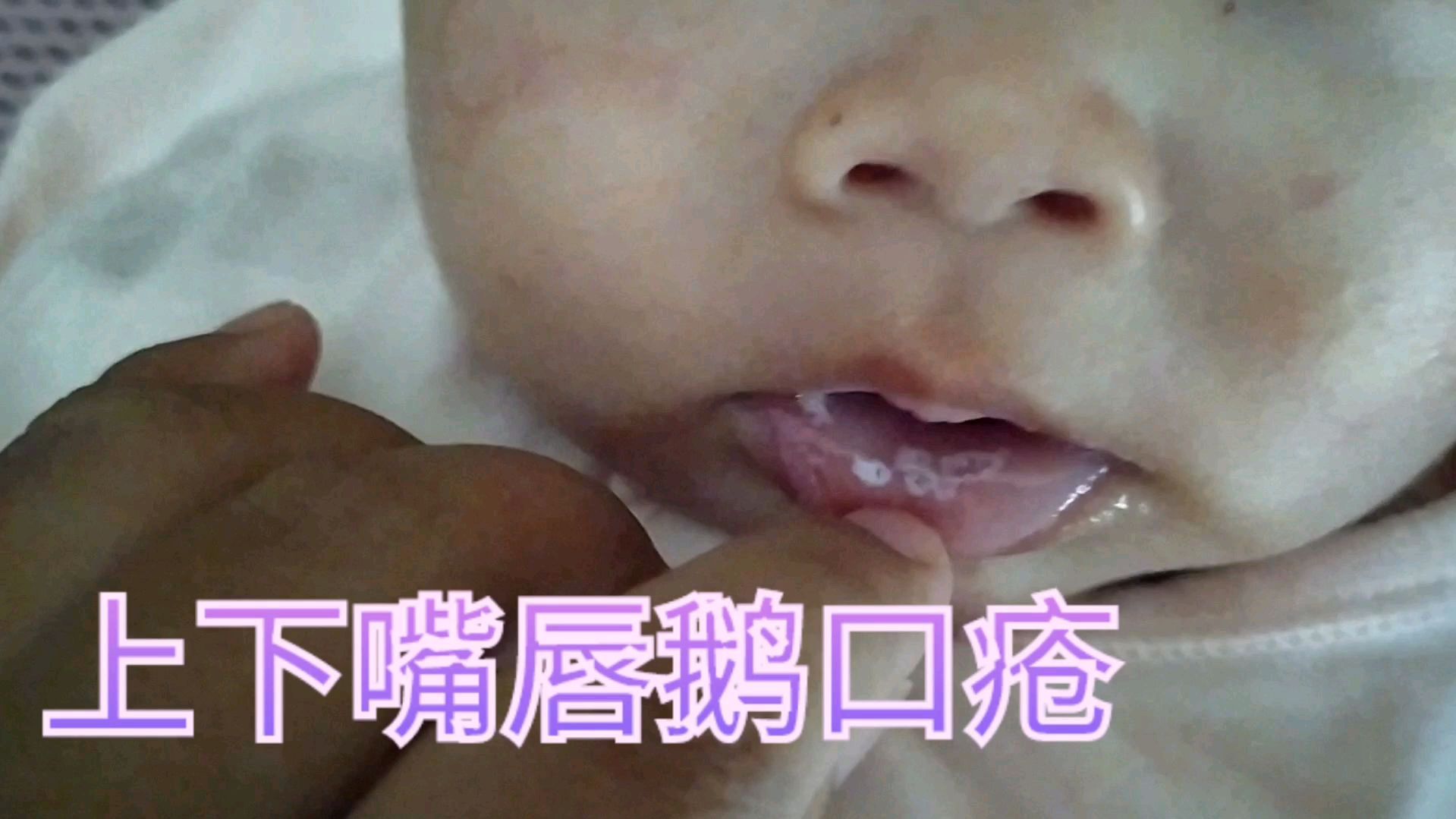 3个月的宝宝长鹅口疮宝妈束手无策求救网友在线等挺急的
