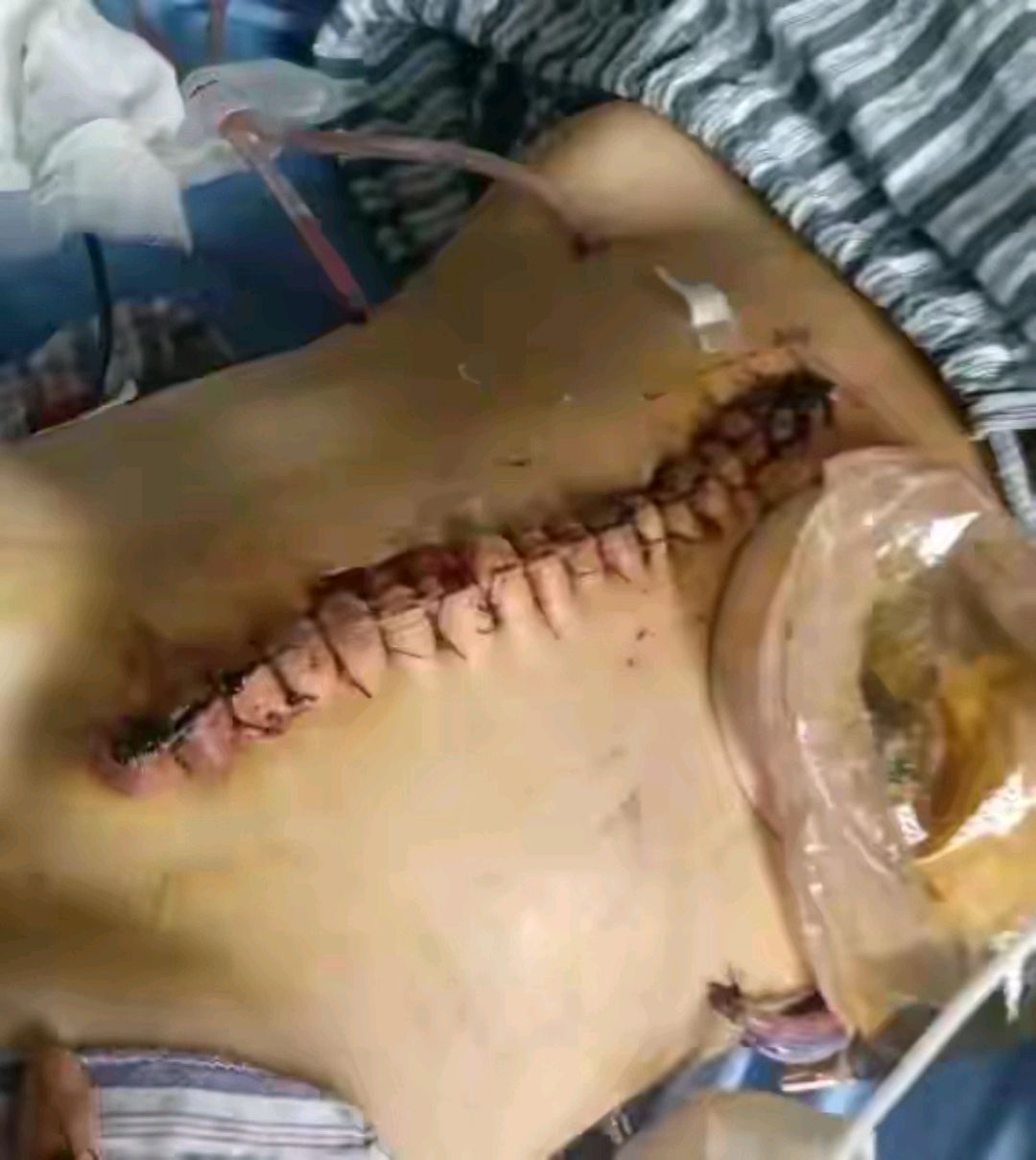 29岁女子被家暴16次 终身挂粪袋 多脏器受损 性命堪忧 娘家人在哪