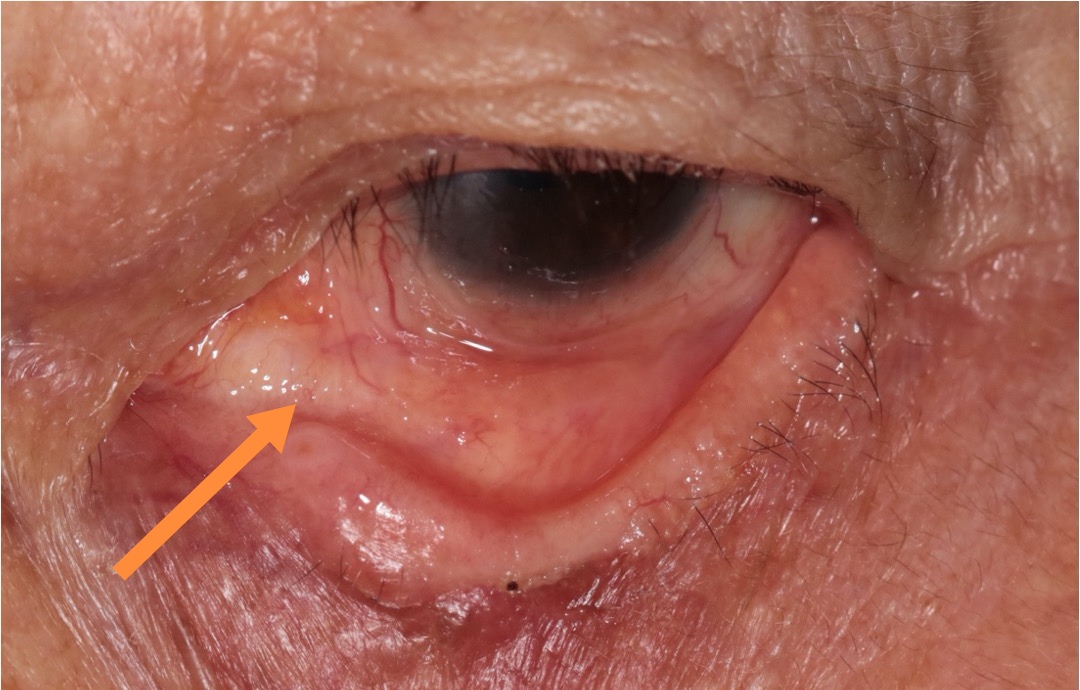 眼部肿瘤科普系列之 眼睑皮脂腺癌只发生在眼睑上吗?