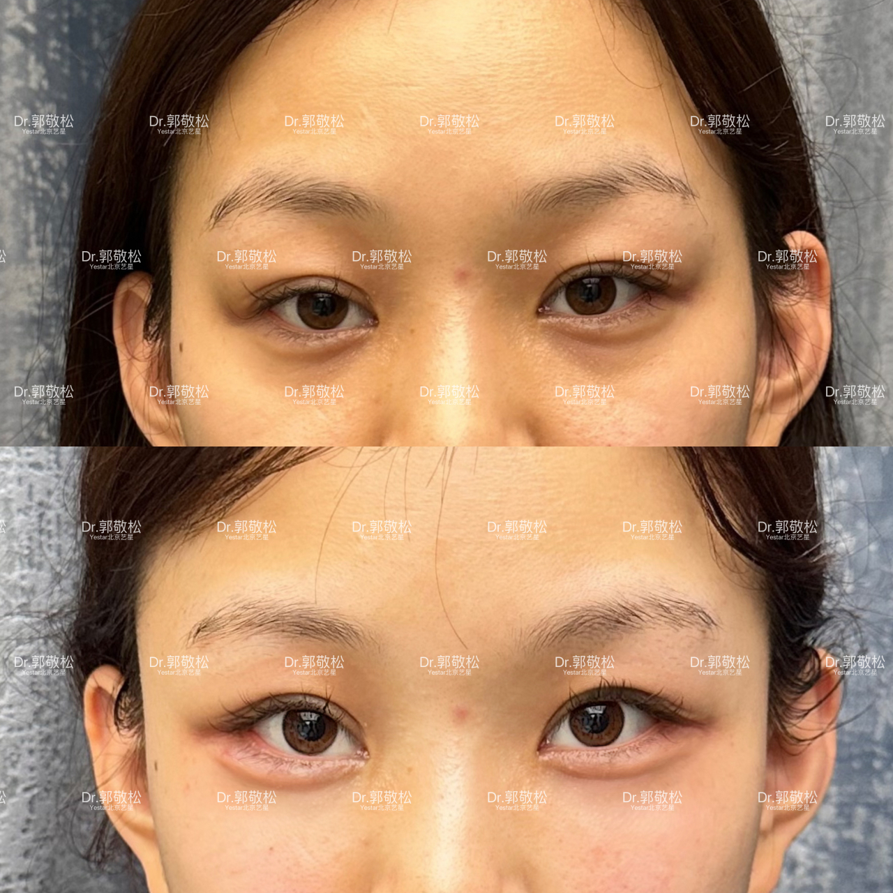 填充卧蚕是玻尿酸好还是自体脂肪好?