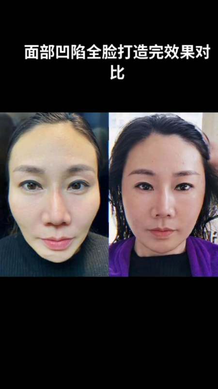 面部凹陷全脸打造完效果对比-度小视