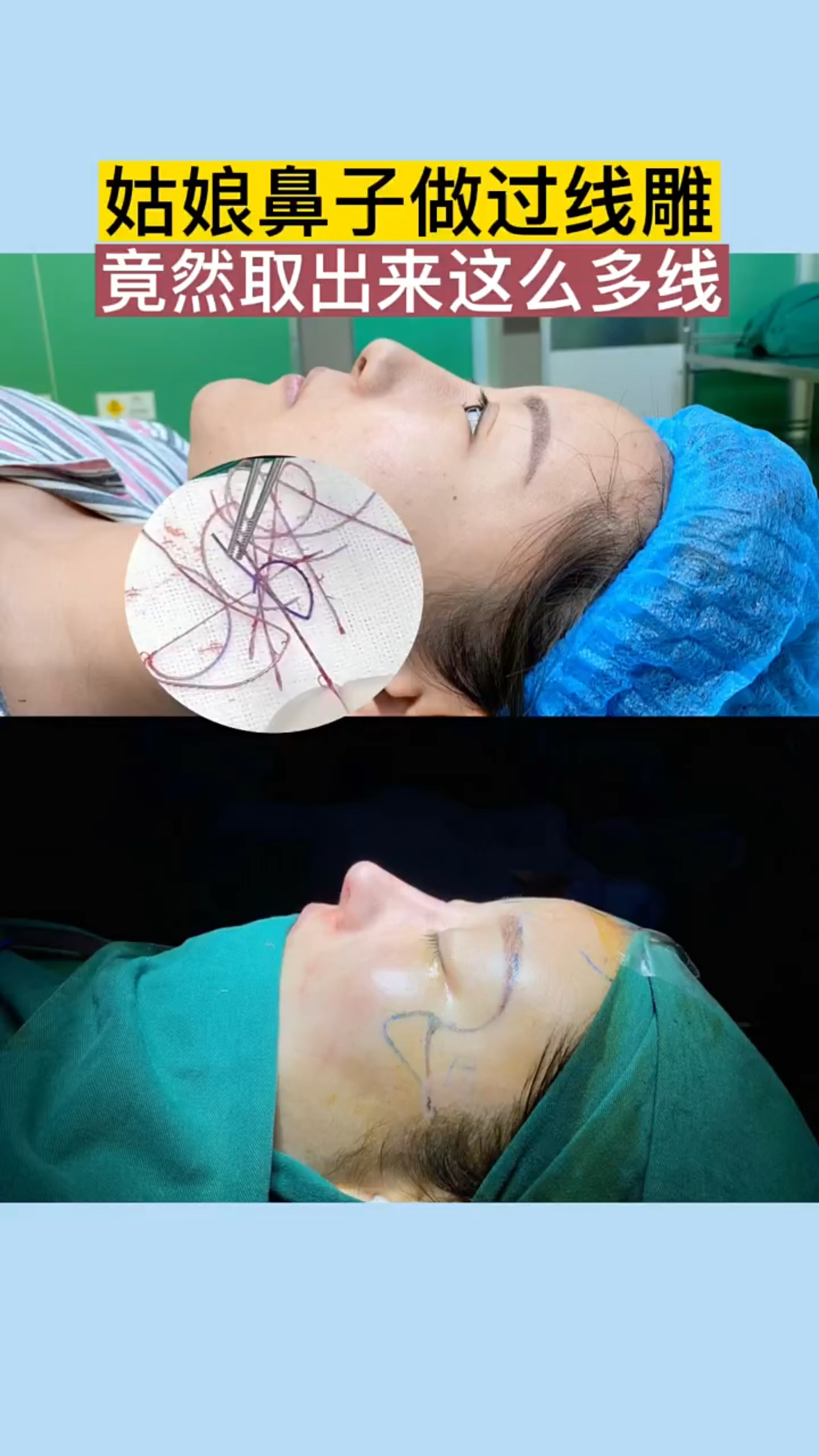姑娘鼻子做过线雕,竟然取出来这么多线