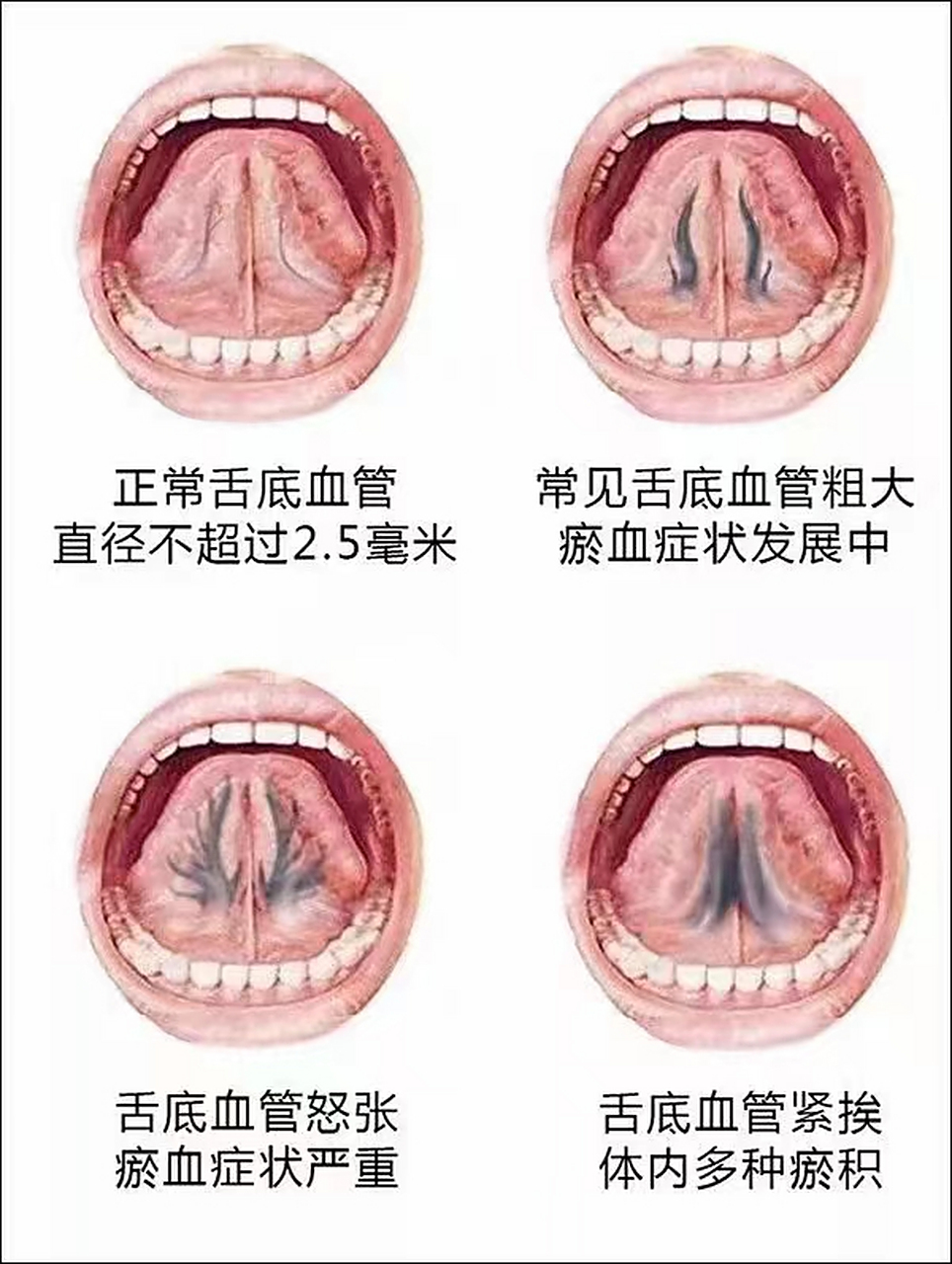 中医如何观察舌下动脉
