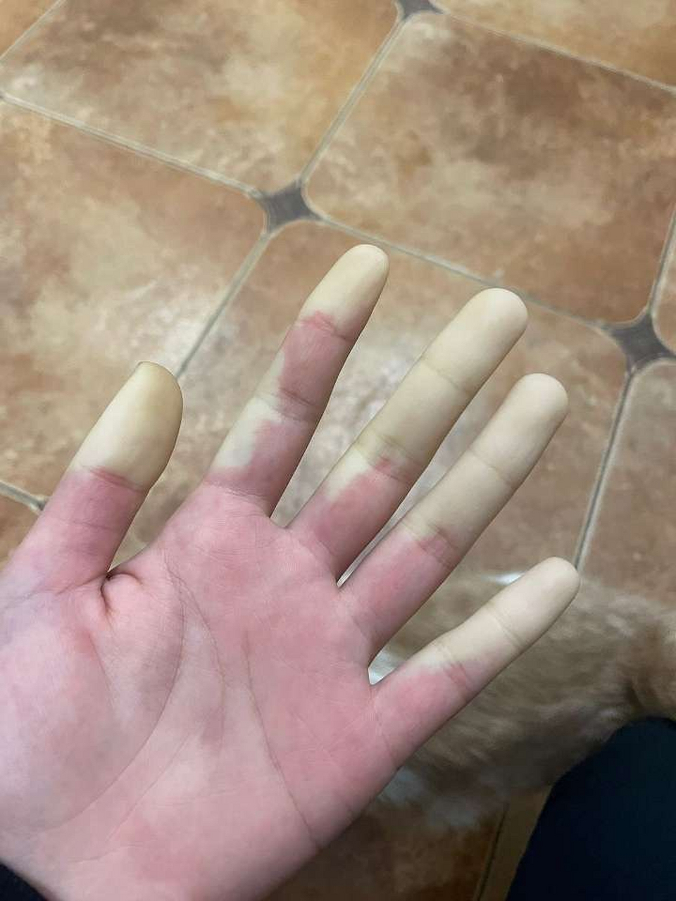 图上这个情况叫雷诺现象,遇冷或者情绪激动的时候,就会出现手指末端