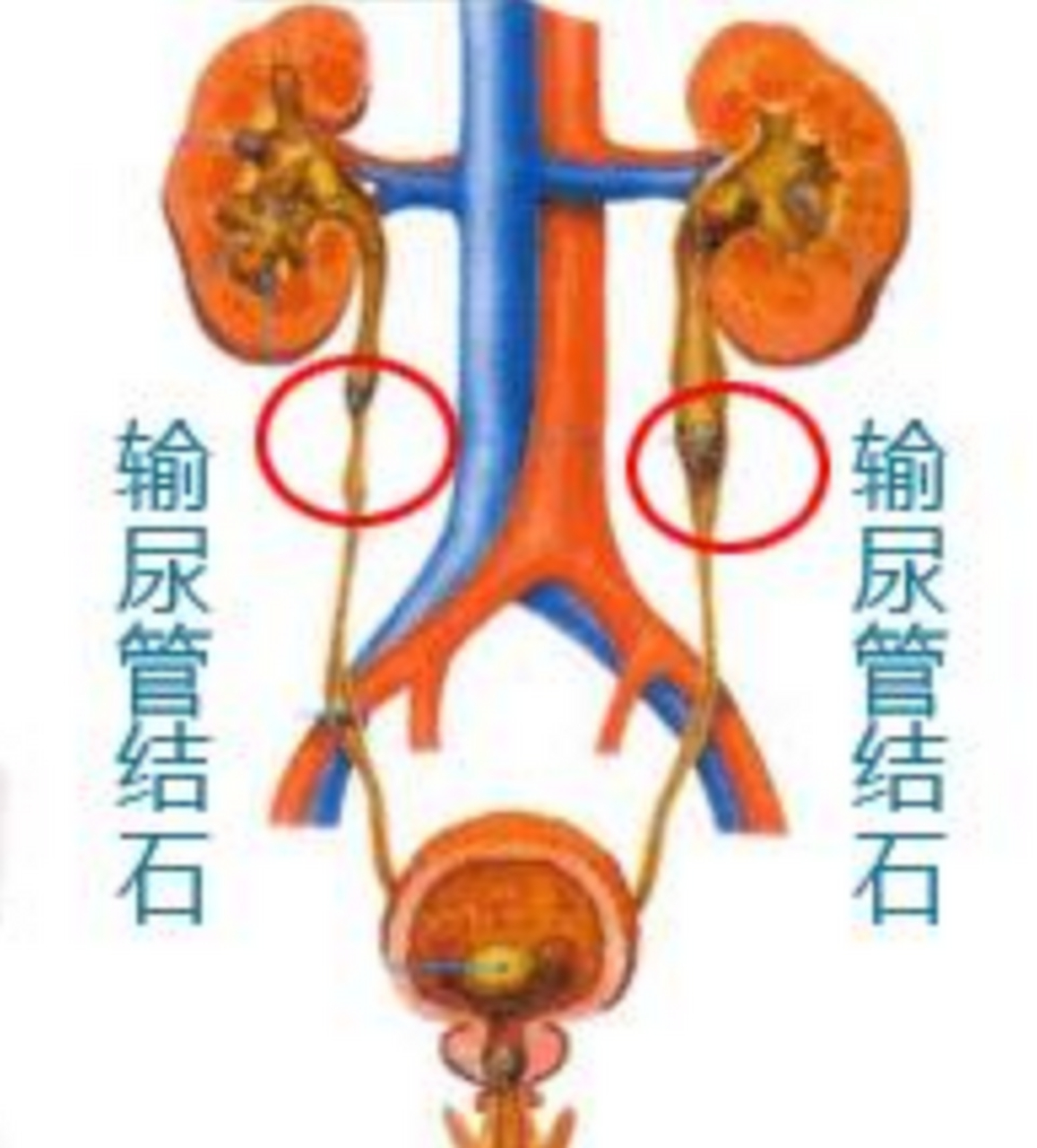 输尿管结石#输尿管结石怎么治疗最好方法#输尿管结石怎么治?
