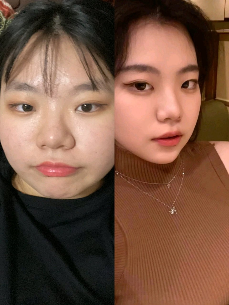 甲减前后对比,甲减好了真的精神多了,人也小了一圈!#甲减