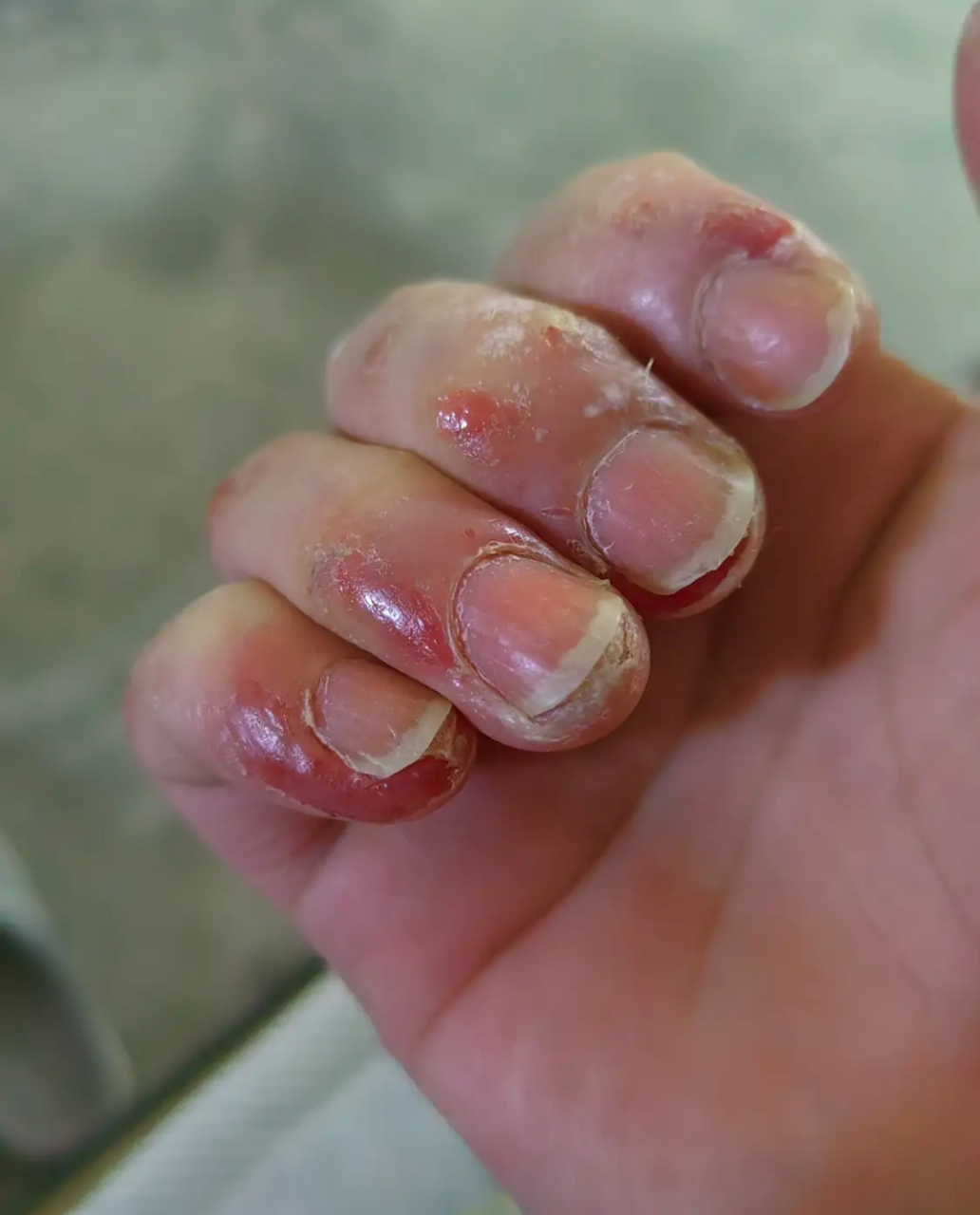 这份工作,干的够够的,手都烂了!不让辞职,还要扣我工钱!